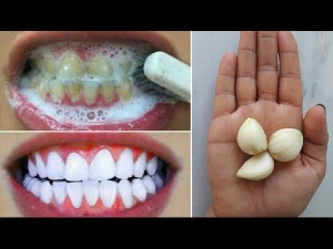 Teeth Whitening