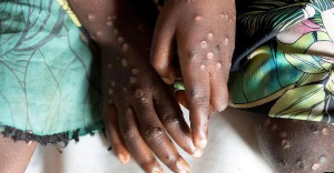 The WHO and African CDC are working to ensure vaccines reach those most at risk