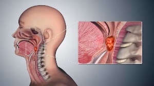 The oropharynx is middle section of the throat (pharynx). Scientific Animations/Wikimedia Commons, C