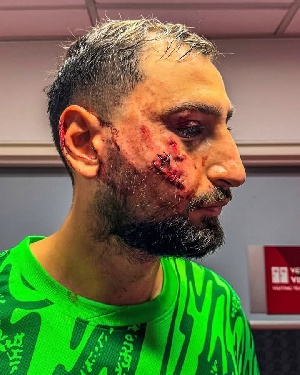 Gianluigi Donnarumma had to be replaced midway through the first half