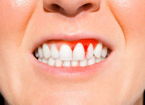 Bleeding Gum