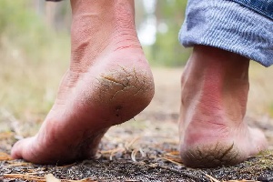 Cracked Heels