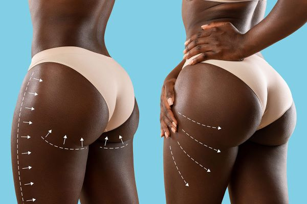 Brazilian Butt Lift